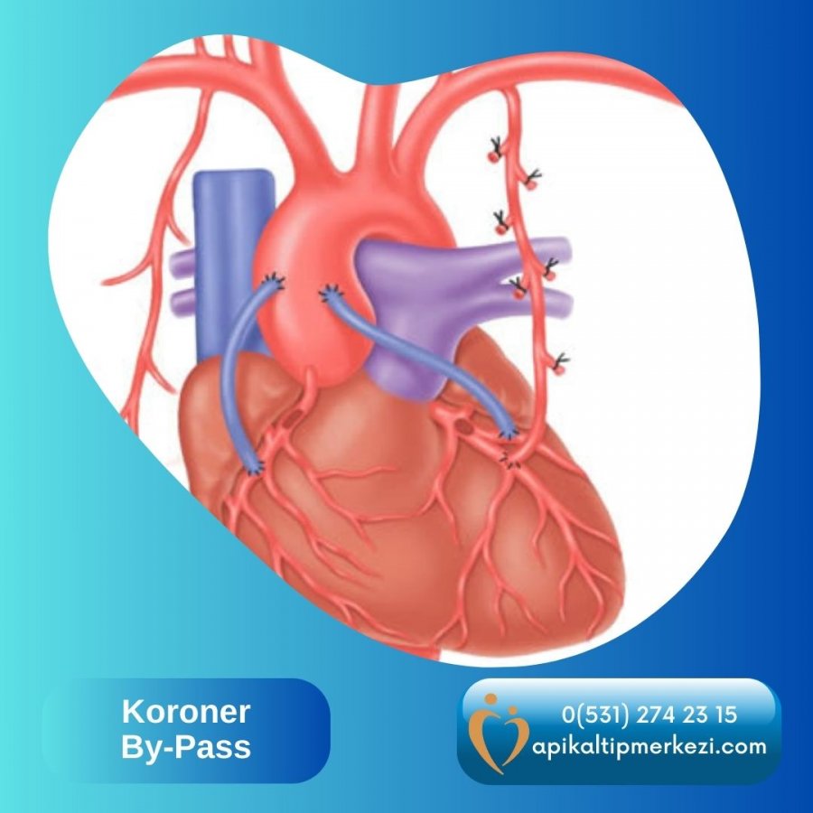 Koroner Bypass
