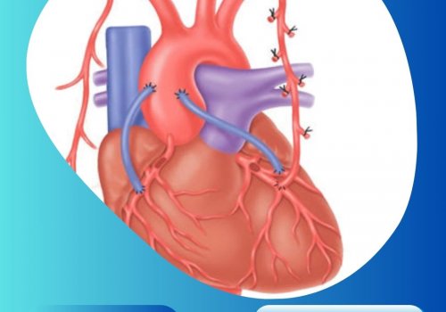 Coronary Bypass