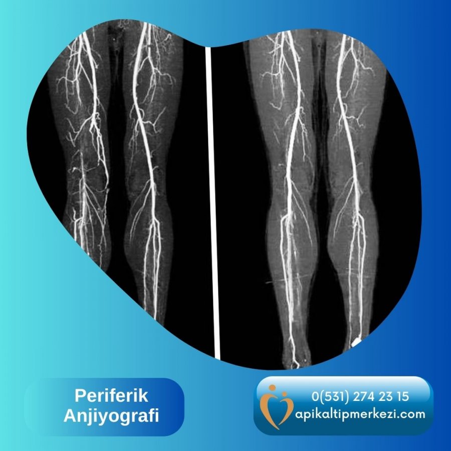 Periferik Anjiyografi