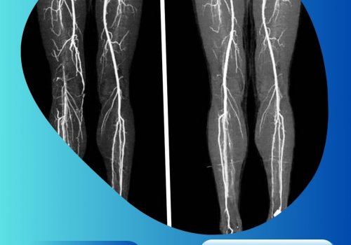 Peripheral Angiography