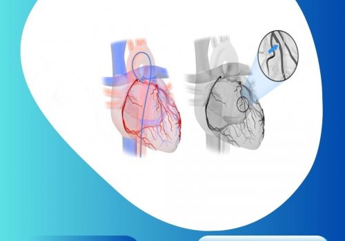 Coronary Angiography